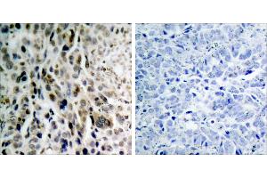 Immunohistochemical analysis of paraffin- embedded lung carcinoma. (CHEK2 antibody  (pThr68))