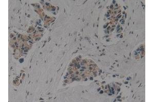 Detection of CK1 in Human Breast cancer Tissue using Polyclonal Antibody to Cytokeratin 1 (CK1) (Cytokeratin 1 antibody  (AA 487-644))