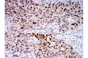 Immunohistochemical analysis of paraffin-embedded cervical cancer tissues using TTF1 mouse mAb with DAB staining.
