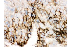 Anti- SLC2A2 Picoband antibody, IHC(P) IHC(P): Human Liver Cancer Tissue (SLC2A2 antibody  (C-Term))