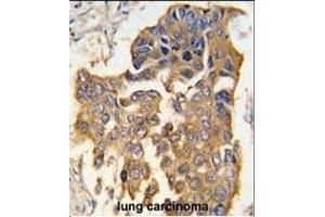 Formalin-fixed and paraffin-embedded human lung carcinoma tissue reacted with CASP9 antibody (Center) (ABIN392509 and ABIN2842072) , which was peroxidase-conjugated to the secondary antibody, followed by DAB staining.