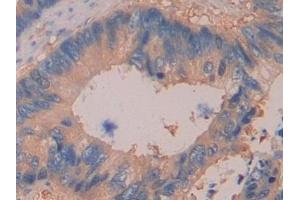 Detection of DDAH2 in Human Colorectal cancer Tissue using Polyclonal Antibody to Dimethylarginine Dimethylaminohydrolase 2 (DDAH2)