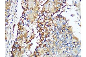 Immunohistochemistry of paraffin-embedded human esophageal using Carbonic Anhydrase 9 (C/G250) Rabbit mAb (ABIN1680827, ABIN3019284, ABIN3019285 and ABIN7101745) at dilution of 1:100 (40x lens). (CA9 antibody)