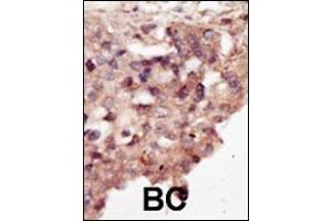 Formalin-fixed and paraffin-embedded human cancer tissue reacted with the primary antibody, which was peroxidase-conjugated to the secondary antibody, followed by DAB staining. (DAPK2 antibody  (N-Term))