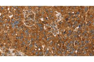 Immunohistochemistry of paraffin-embedded Human breast cancer tissue using TBC1D1 Polyclonal Antibody at dilution 1:45