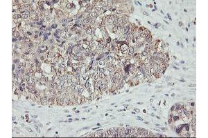 Immunohistochemical staining of paraffin-embedded Adenocarcinoma of Human ovary tissue using anti-AGPAT5 mouse monoclonal antibody. (AGPAT5 antibody)
