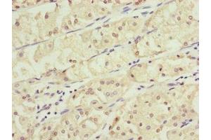 Immunohistochemistry of paraffin-embedded human gastric cancer using ABIN7157235 at dilution of 1:100 (KANSL3 antibody  (AA 1-200))
