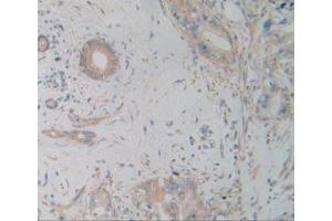 IHC-P analysis of Human Cholangiocarcinoma Tissue, with DAB staining. (alpha Actinin 4 antibody  (AA 1-269))