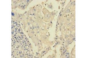 Immunohistochemistry of paraffin-embedded human lung cancer using ABIN7172870 at dilution of 1:100 (TRPM8 antibody  (AA 1-192))