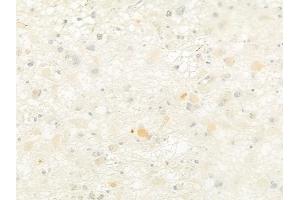 ABIN6259971 and ABIN6279117 at 1/100 staining human astrocytoma by IHC-P.