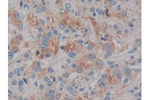 Detection of IL2 in Human Prostate cancer Tissue using Monoclonal Antibody to Interleukin 2 (IL2) (IL-2 antibody  (AA 21-153))