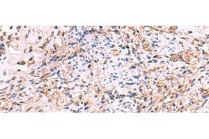 Immunohistochemistry of paraffin-embedded Human cervical cancer tissue using OSBPL2 Polyclonal Antibody at dilution of 1:55(x200) (OSBPL2 antibody)