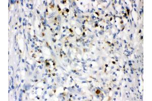 Anti- Lipocalin 2 Picoband antibody, IHC(P) IHC(P): Human Intestinal Cancer Tissue (Lipocalin 2 antibody  (AA 21-198))