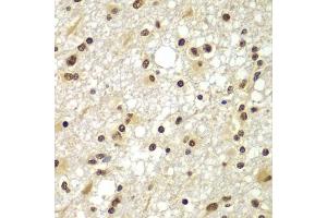 Immunohistochemistry of paraffin-embedded human brain cancer using ZNF20 antibody  at dilution of 1:100 (40x lens). (ZNF20 antibody  (AA 1-200))