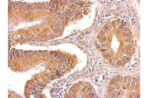 IHC-P Image TIP30 antibody detects TIP30 protein on human gastric cancer by immunohistochemical analysis. (HIV-1 Tat Interactive Protein 2, 30kDa (HTATIP2) antibody)