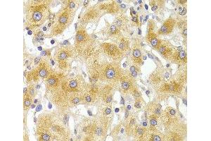 Immunohistochemistry of paraffin-embedded Human liver damage using EIF4G1 Polyclonal Antibody at dilution of 1:100 (40x lens). (EIF4G1 antibody)