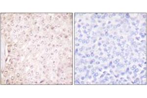 Immunohistochemistry analysis of paraffin-embedded human breast carcinoma tissue, using Stefin B Antibody. (CSTB antibody  (AA 49-98))