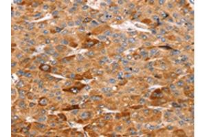 The image on the left is immunohistochemistry of paraffin-embedded Human liver cancer tissue using ABIN7192504(SLC5A11 Antibody) at dilution 1/25, on the right is treated with synthetic peptide.