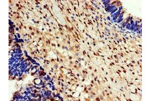 Immunohistochemistry of paraffin-embedded human ovarian cancer using ABIN7152101 at dilution of 1:100 (EEF2K antibody  (AA 201-500))