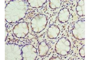 Immunohistochemistry of paraffin-embedded human colon cancer using ABIN7169893 at dilution of 1:100 (SUMO4 antibody  (AA 1-95))