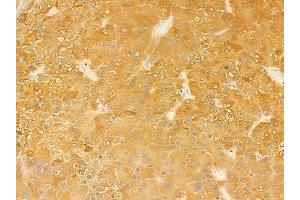 ABIN6262436 and ABIN6279508 at 1/100 staining human hepatocellular carcinoma by IHC-P.