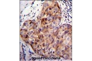 SCUBE2 Antibody (Center ) (ABIN655409 and ABIN2844955) immunohistochemistry analysis in formalin fixed and paraffin embedded human breast carcinoma followed by peroxidase conjugation of the secondary antibody and DAB staining. (SCUBE2 antibody  (AA 251-280))