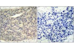 Immunohistochemistry analysis of paraffin-embedded human breast carcinoma, using LIMK1 (Phospho-Thr508) Antibody. (LIM Domain Kinase 1 antibody  (pThr508))