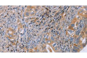 Immunohistochemistry of paraffin-embedded Human cervical cancer using GMFG Polyclonal Antibody at dilution of 1:50 (GMFG antibody)