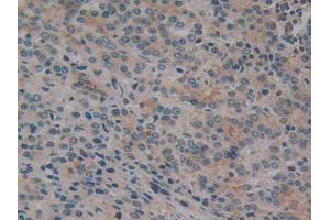 IHC-P analysis of Human Prostate Gland Cancer Tissue, with DAB staining. (CYLD antibody  (AA 170-338))