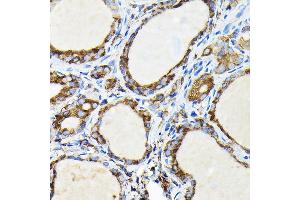 Immunohistochemistry of paraffin-embedded human thyroid cancer using FA Rabbit pAb (ABIN7267102) at dilution of 1:100 (40x lens). (FAM117A antibody)