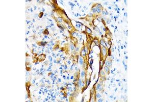Immunohistochemistry of paraffin-embedded human lung squamous carcinoma tissue using Cytokeratin 13 (KRT13) (KRT13) Rabbit mAb (ABIN7268089) at dilution of 1:100 (40x lens). (Cytokeratin 13 antibody)