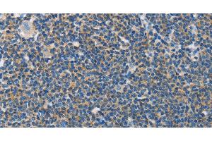 Immunohistochemistry of paraffin-embedded Human lymphoma tissue using NEK5 Polyclonal Antibody at dilution 1:60 (NEK5 antibody)