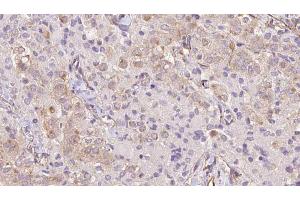 ABIN6273334 at 1/100 staining Human thyroid cancer tissue by IHC-P. (TRIM14 antibody  (C-Term))