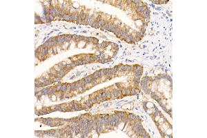 Immunohistochemistry of paraffin-embedded human colon carcinoma using eIF1A Rabbit mAb (ABIN7267027) at dilution of 1:50 (40x lens). (Eukaryotic Translation Initiation Factor 1A (EIF1A) antibody)