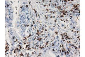 Immunohistochemical staining of paraffin-embedded Adenocarcinoma of Human colon tissue using anti-DEF8 mouse monoclonal antibody. (DEF8 antibody)