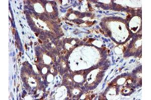Immunohistochemical staining of paraffin-embedded Adenocarcinoma of Human colon tissue using anti-LIMK1 mouse monoclonal antibody. (LIM Domain Kinase 1 antibody)