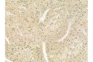 ABIN6259798 and ABIN6277719 at 1/100 staining human hepatocellular carcinoma by IHC-P. (ADH6 antibody  (C-Term))