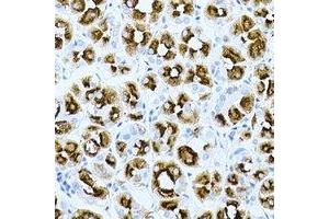 Immunohistochemical analysis of GHRH staining in human gastric cancer formalin fixed paraffin embedded tissue section. (GHRH antibody)