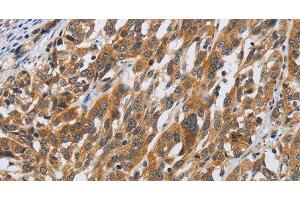 Immunohistochemistry of paraffin-embedded Human esophagus cancer tissue using DSP Polyclonal Antibody at dilution 1:40 (Desmoplakin antibody)