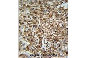 WDR43 Antibody (C-term) (ABIN651679 and ABIN2840356) immunohistochemistry analysis in formalin fixed and paraffin embedded human Cervix carcinoma followed by peroxidase conjugation of the secondary antibody and DAB staining. (WDR43 antibody  (C-Term))