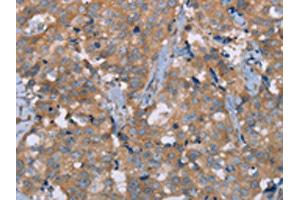 The image on the left is immunohistochemistry of paraffin-embedded Human breast cancer tissue using ABIN7191717(NRG3 Antibody) at dilution 1/30, on the right is treated with synthetic peptide. (Neuregulin 3 antibody)