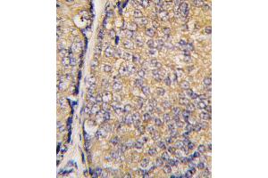 Formalin-fixed and paraffin-embedded human prostate carcinoma tissue reacted with STAP1 antibody (N-term)(F56) , which was peroxidase-conjugated to the secondary antibody, followed by DAB staining. (STAP1 antibody  (N-Term))