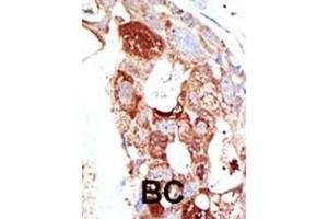 Formalin-fixed and paraffin-embedded human cancer tissue reacted with the primary antibody, which was peroxidase-conjugated to the secondary antibody, followed by DAB staining. (SENP6 antibody  (C-Term))