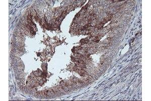 Immunohistochemical staining of paraffin-embedded Adenocarcinoma of Human endometrium tissue using anti-RLBP1 mouse monoclonal antibody.