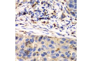 Immunohistochemistry of paraffin-embedded human esophageal cancer using S100A8 antibody at dilution of 1:100 (400x lens). (S100A8 antibody)