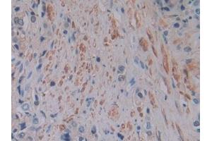 Detection of FTL in Human Prostate cancer Tissue using Polyclonal Antibody to Ferritin, Light Polypeptide (FTL) (FTL antibody  (AA 2-175))