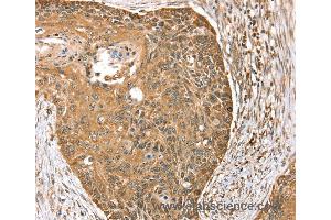 Immunohistochemistry of Human esophagus cancer using MORF4L1 Polyclonal Antibody at dilution of 1:35 (MORF4L1 antibody)