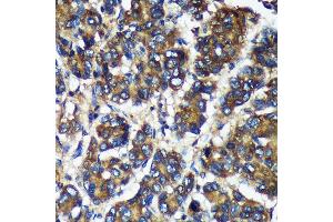 Immunohistochemistry of paraffin-embedded Human liver cancer using TMX2 Rabbit pAb (ABIN7270810) at dilution of 1:100 (40x lens). (TMX2 antibody  (AA 128-296))