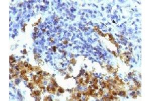 IHC testing of FFPE human lung adenocarcinoma with Napsin-A antibody (clone NPSNA-1). (NAPSA antibody)