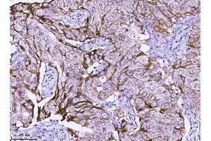 IHC analysis of ErbB 2 using anti-ErbB 2 antibody (ABIN5518830).